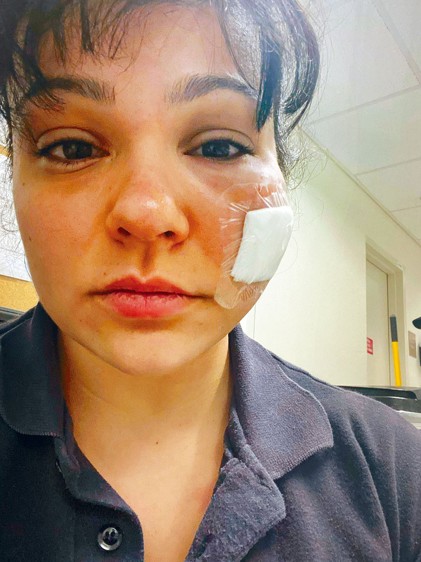 女救護員在行動中被精神失常少女咬傷臉頰。推特圖片
